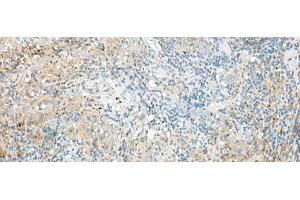 Immunohistochemistry of paraffin-embedded Human cervical cancer tissue using RPP14 Polyclonal Antibody at dilution of 1:60(x200) (RPP14 anticorps)