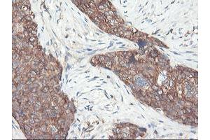 Immunohistochemical staining of paraffin-embedded Adenocarcinoma of Human breast tissue using anti-PFKP mouse monoclonal antibody. (PFKP anticorps)