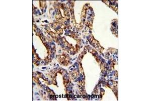 Formalin-fixed and paraffin-embedded human prostate carcinoma with TROP2 Antibody (Center), which was peroxidase-conjugated to the secondary antibody, followed by DAB staining. (TACSTD2 anticorps  (AA 162-190))
