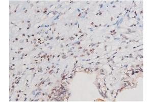 ABIN6267502 at 1/200 staining Human prostate cancer tissue sections by IHC-P.