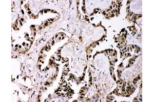 IHC-P: GSTP1 antibody testing of human lung cancer tissue (GSTP1 anticorps  (AA 2-210))
