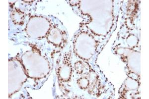 Formalin-fixed, paraffin-embedded human Thyroid Carcinoma stained with MSH2 Mouse Monoclonal Antibody (MSH2/2622).