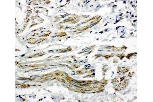 IHC-P: Caveolin-2 antibody testing of human lung cancer tissue