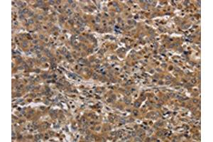 The image on the left is immunohistochemistry of paraffin-embedded Human liver cancer tissue using ABIN7192097(RAB22A Antibody) at dilution 1/20, on the right is treated with synthetic peptide.