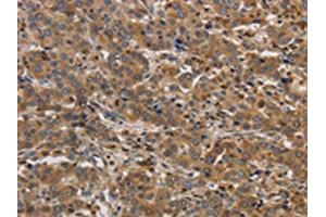 The image on the left is immunohistochemistry of paraffin-embedded Human liver cancer tissue using ABIN7192097(RAB22A Antibody) at dilution 1/20, on the right is treated with synthetic peptide. (RAB22A anticorps)