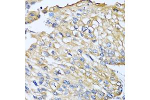 Immunohistochemistry of paraffin-embedded human prostate cancer using CCL8 antibody (ABIN5975074) at dilution of 1/100 (40x lens).