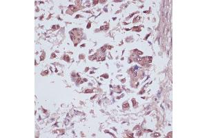 Immunohistochemistry of paraffin-embedded human lung cancer using U2 antibody (ABIN6134442, ABIN6149752, ABIN6149755 and ABIN6217061) at dilution of 1:100 (40x lens). (U2AF1 anticorps  (AA 1-100))