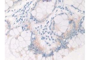 Detection of IL12A in Human Colorectal cancer Tissue using Polyclonal Antibody to Interleukin 12A (IL12A)