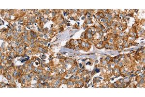 Immunohistochemistry of paraffin-embedded Human breast cancer using PPOX Polyclonal Antibody at dilution of 1:40 (PPOX anticorps)