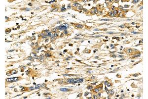 ABIN6262457 and ABIN6278271 at 1/100 staining Human gastric cancer by IHC-P.