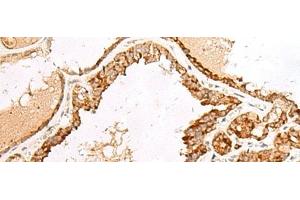 Immunohistochemistry of paraffin-embedded Human thyroid cancer tissue using LGALSL Polyclonal Antibody at dilution of 1:70(x200) (GRP anticorps)