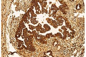 ABIN6262955 and ABIN6272923 at 1/100 staining Human pancreatic cancer by IHC-P. (LGALS3BP anticorps  (C-Term))