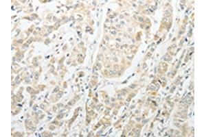 The image on the left is immunohistochemistry of paraffin-embedded Human breast cancer tissue using ABIN7189714(AGBL1 Antibody) at dilution 1/15, on the right is treated with synthetic peptide. (AGBL1 anticorps)