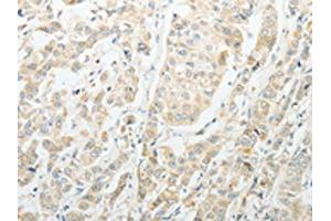 The image on the left is immunohistochemistry of paraffin-embedded Human breast cancer tissue using ABIN7189714(AGBL1 Antibody) at dilution 1/15, on the right is treated with synthetic peptide. (AGBL1 anticorps)