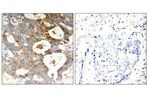 Immunohistochemical analysis of paraffin-embedded human breast carcinoma tissue using IkB-ε (Phospho-Ser22) antibody (E011213). (NFKBIE anticorps  (pSer22))