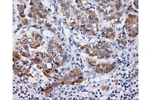 Immunohistochemical staining of paraffin-embedded Carcinoma of prostate tissue using anti-LIPG mouse monoclonal antibody. (LIPG anticorps)