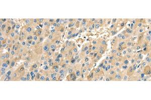 Immunohistochemistry of paraffin-embedded Human liver cancer tissue using COX2 Polyclonal Antibody at dilution 1:40 (COX2 anticorps)