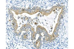 IHC analysis of Cytokeratin 8 using anti-Cytokeratin 8 antibody (ABIN6719478). (KRT8 anticorps  (AA 107-325))