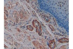 DAB staining on IHC-P; Samples: Human Esophagus cancer Tissue (SNCG anticorps  (AA 1-121))
