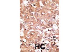 Formalin-fixed and paraffin-embedded human hepatocellular carcinoma tissue reacted with GDF2 polyclonal antibody  , which was peroxidase-conjugated to the secondary antibody, followed by DAB staining. (GDF2 anticorps  (N-Term))