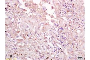 Formalin-fixed and paraffin embedded human lung carcinoma labeled with Anti-CD71/TFR/Transferrin Polyclonal Antibody, Unconjugated (ABIN1386360) at 1:200 followed by conjugation to the secondary antibody and DAB staining. (Transferrin Receptor anticorps  (AA 621-720))