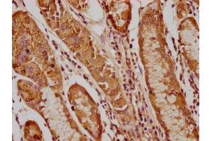 IHC image of ABIN7163202 diluted at 1:200 and staining in paraffin-embedded human gastric cancer performed on a Leica BondTM system.