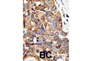Formalin-fixed and paraffin-embedded human cancer tissue reacted with the PIAS4 polyclonal antibody  , which was peroxidase-conjugated to the secondary antibody, followed by DAB staining. (PIAS4 anticorps  (C-Term))