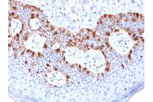 Formalin-fixed, paraffin-embedded human Melanoma stained with MART-1 Mouse Recombinant Monoclonal Antibody (rMLANA/788). (Recombinant MLANA anticorps)