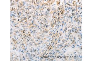 Immunohistochemistry of Human gastic cancer using NPPC Polyclonal Antibody at dilution of 1:70 (NPPC anticorps)