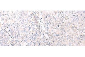 Immunohistochemistry of paraffin-embedded Human cervical cancer tissue using HLA-C Polyclonal Antibody at dilution of 1:25(x200) (HLA-C anticorps)