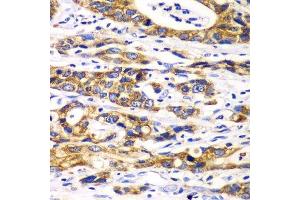 Immunohistochemistry of paraffin-embedded human gastric cancer using RPN1 antibody.