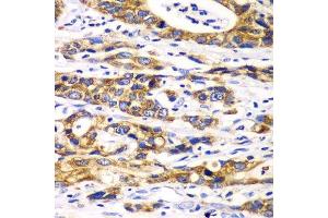 Immunohistochemistry of paraffin-embedded human gastric cancer using RPN1 antibody. (RPN1 anticorps  (AA 20-280))