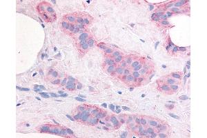 Anti-KDR / VEGFR2 antibody IHC of human Breast, Carcinoma. (VEGFR2/CD309 anticorps  (Internal Region))