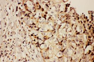 Anti-RFC1 antibody, IHC(P) IHC(P): Human Mammary Cancer Tissue (RFC1 anticorps  (N-Term))