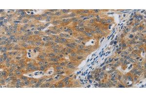 Immunohistochemistry of paraffin-embedded Human ovarian cancer using F2R Polyclonal Antibody at dilution of 1:40 (PAR1 anticorps)