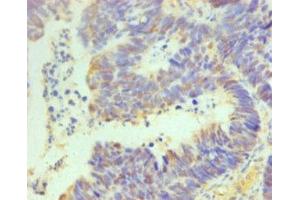 Immunohistochemistry of paraffin-embedded human ovarian cancer using ABIN7164069 at dilution of 1:100 (OCT4 anticorps  (AA 1-360))