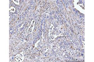 IHC analysis of MT-ND5 using anti-MT-ND5 antibody (ABIN7600145). (MT-ND5 anticorps  (AA 154-570))