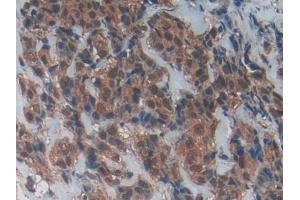 DAB staining on IHC-P; Samples: Human Breast cancer Tissue (CD40 Ligand anticorps  (AA 180-261))