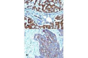 Immunohistochemical staining (Formalin-fixed paraffin-embedded sections) of (A) human hepatocellular carcinoma and (B) human ovarian carcinoma with RBP1 monoclonal antibody, clone RBP/872 . (RBP1 anticorps)