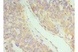 Immunohistochemistry of paraffin-embedded human endometrial cancer using ABIN7156580 at dilution of 1:100 (IFNAR2 anticorps  (AA 27-243))