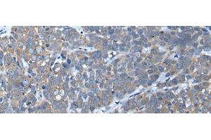 Immunohistochemistry of paraffin-embedded Human thyroid cancer tissue using UBAC2 Polyclonal Antibody at dilution of 1:50(x200) (UBAC2 anticorps)