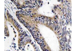 Immunohistochemical analysis of paraffin-embedded human colon cancer tissue using IQCB1 polyclonal antibody . (IQCB1 anticorps)