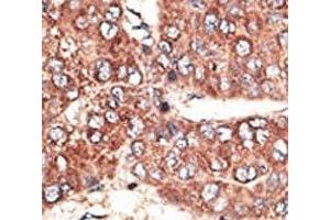 IHC analysis of FFPE human hepatocarcinoma tissue stained with the Megalin antibody (LRP2 anticorps  (AA 4626-4655))