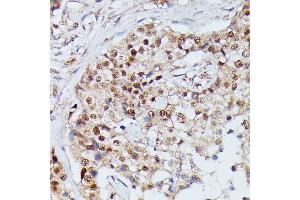Immunohistochemistry of paraffin-embedded human mammary cancer using IGHMBP2 antibody (ABIN7267848) at dilution of 1:100 (40x lens). (IGHMBP2 anticorps  (AA 540-720))