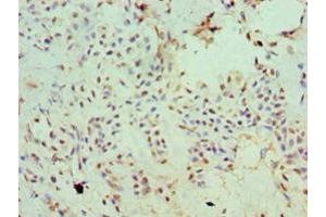 Immunohistochemistry of paraffin-embedded human breast cancer using ABIN7170006 at dilution of 1:100 (SLC2A2 anticorps  (AA 235-485))