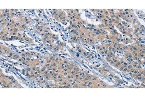 Immunohistochemistry of paraffin-embedded Human gastric cancer using KLF7 Polyclonal Antibody at dilution of 1:60 (KLF7 anticorps)