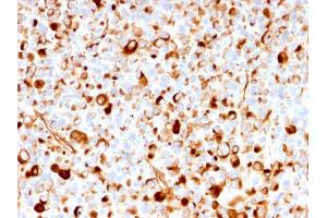 Formalin-fixed, paraffin-embedded human Melanoma stained with NGFR Mouse Recombinant Monoclonal Antibody (rNGFR/1965).