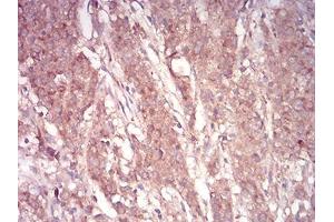 Immunohistochemical analysis of paraffin-embedded stomach cancer tissues using ARF1 mouse mAb with DAB staining. (ARF1 anticorps  (AA 76-182))