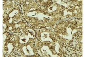 ABIN6273244 at 1/100 staining Human breast cancer tissue by IHC-P. (FBXW7 anticorps)
