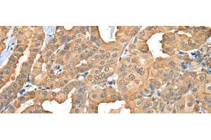 Immunohistochemistry of paraffin-embedded Human thyroid cancer tissue using C1GALT1C1 Polyclonal Antibody at dilution of 1:45(x200)